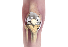 Lateral Approach Total Knee Replacement