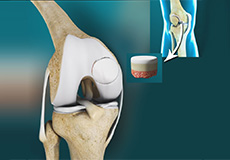 Osteochondral Defect of the Knee