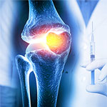Study Finds Corticosteroid Injections May Not Hasten Progression of Knee OA